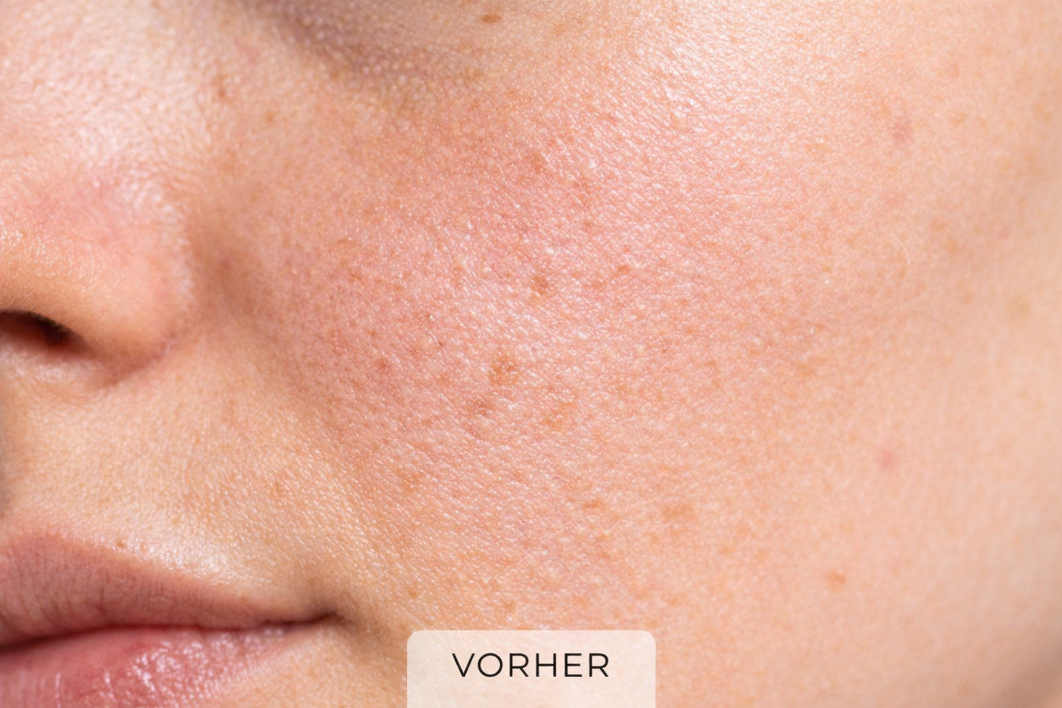 vorher Aqua Fusion Hautbild